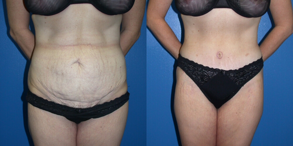 Before and After Image