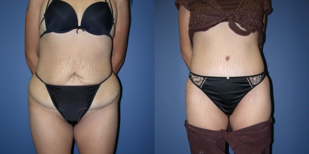 Tummy Tuck (Abdominoplasty) in Houston, TX