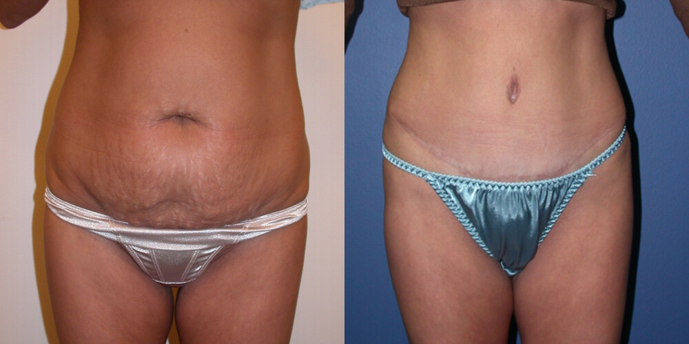 Before and After Image