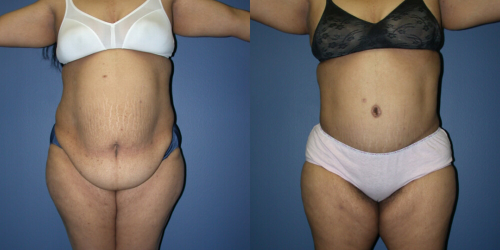 Before and After Image