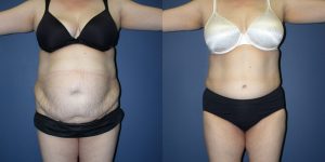 Before and After Image