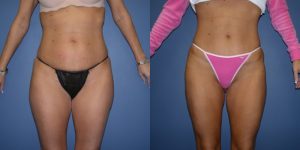 Before and After Image