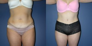 Before and After Image