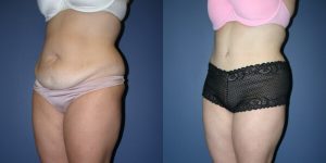 Before and After Image